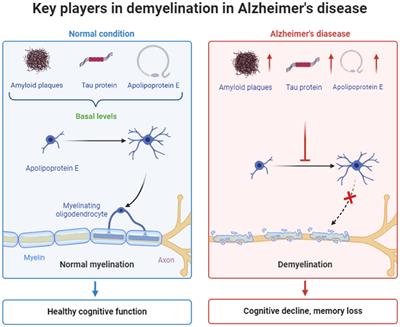 Stimulating myelin restoration with BDNF: a promising therapeutic approach for Alzheimer's disease